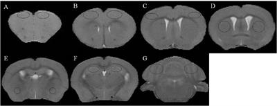 Application of 9.4T MRI in Wilson Disease Model TX Mice With Quantitative Susceptibility Mapping to Assess Copper Distribution
